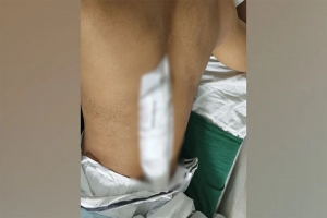 রাজধানীতে ইমিগ্রেশন পুলিশের এসআইকে কু পি য়ে জ খ ম, পিঠে ৪৩ সেলাই
